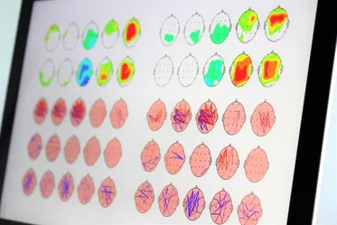 qEEG - Neurofeedback München